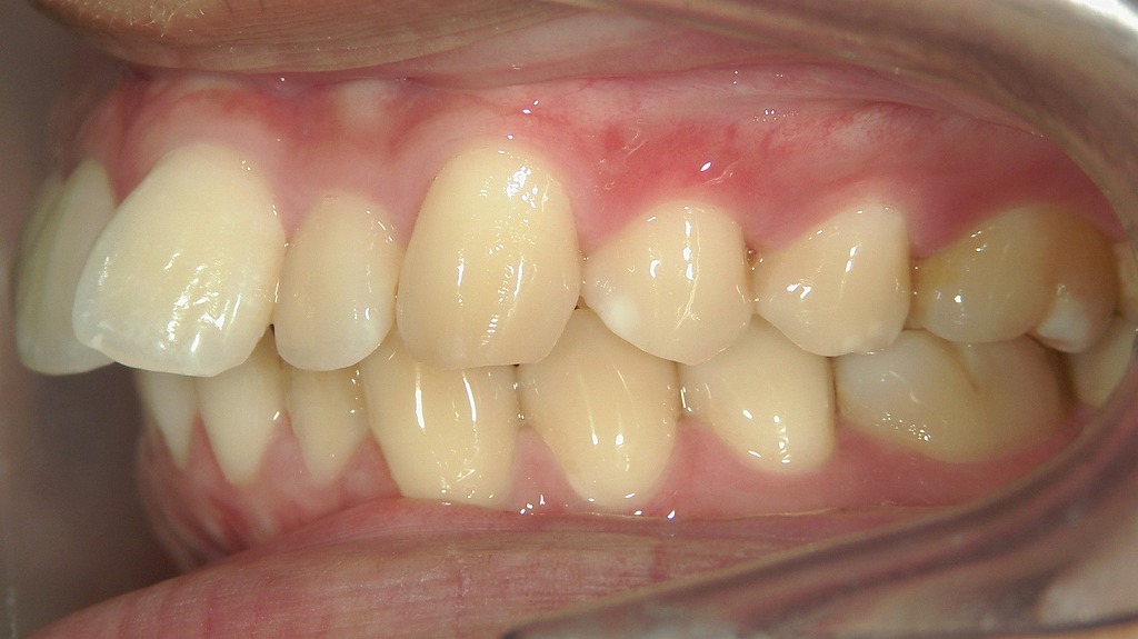 前歯が前に出ているタイプの出っ歯。口元をすっきりさせたい場合、抜歯矯正が有効となることがあります。