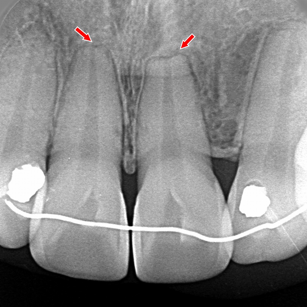 矯正力の過負荷による前歯の歯根吸収