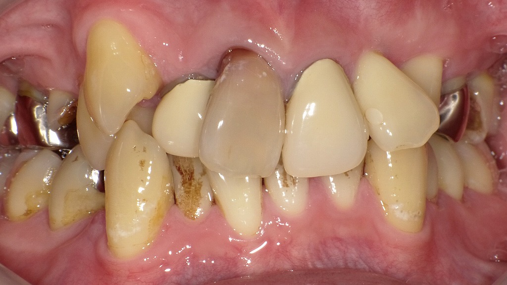 重度のガタつき（叢生）がある場合、抜歯矯正によりスペースを確保することで、噛み合わせの改善・清掃性の向上が期待できます。