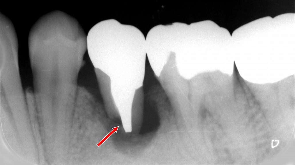 下顎5番の病的歯根吸収。炎症などにより永久歯の歯根が異常に溶けている所見。
