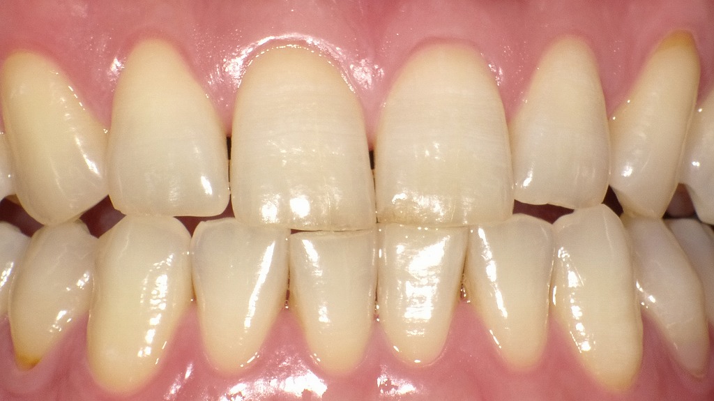 2枚目:ホワイトニング後