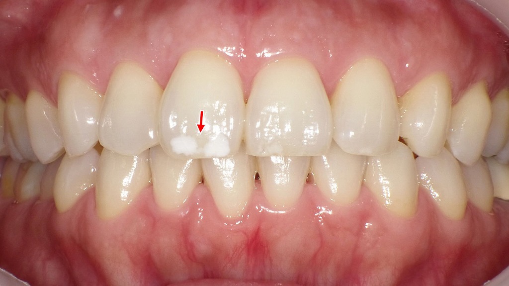 治療前、前歯の表面に白く濁ったホワイトスポットが確認できます(矢印部)