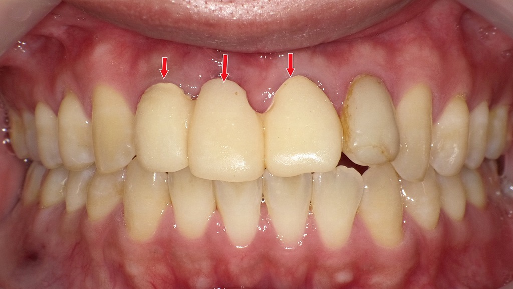 前歯部の仮歯（プロビジョナル）装着による形態・噛み合わせの確認