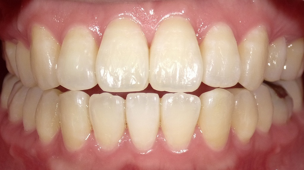 ホワイトニング後（After）