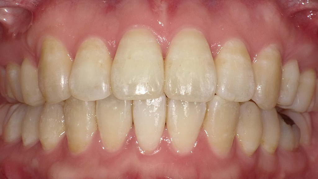 ホワイトニング前（Before）