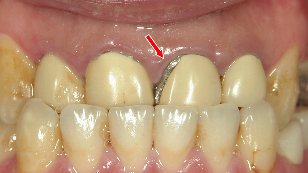 前装部が欠けた症例