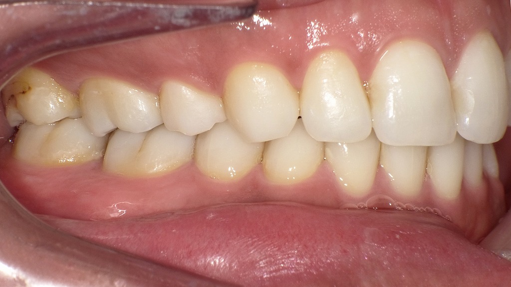 抜歯矯正後の右側面観