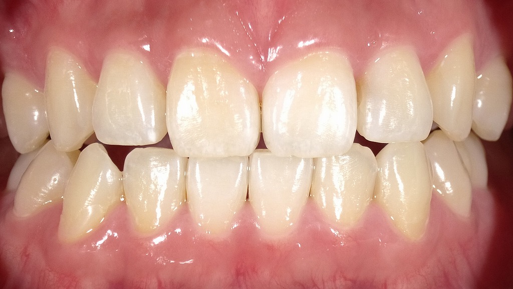 2枚目の画像:ホワイトニング後