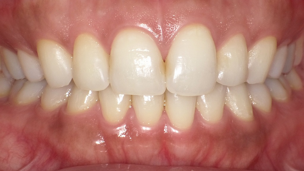 抜歯矯正後の正面観