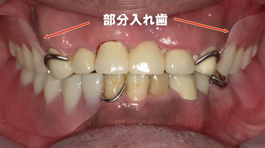 重度う蝕・補綴不良症例の治療後(正面観)