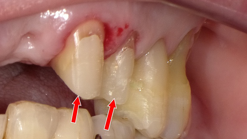 金属コアを除去し、歯にやさしいファイバーコアへ交換