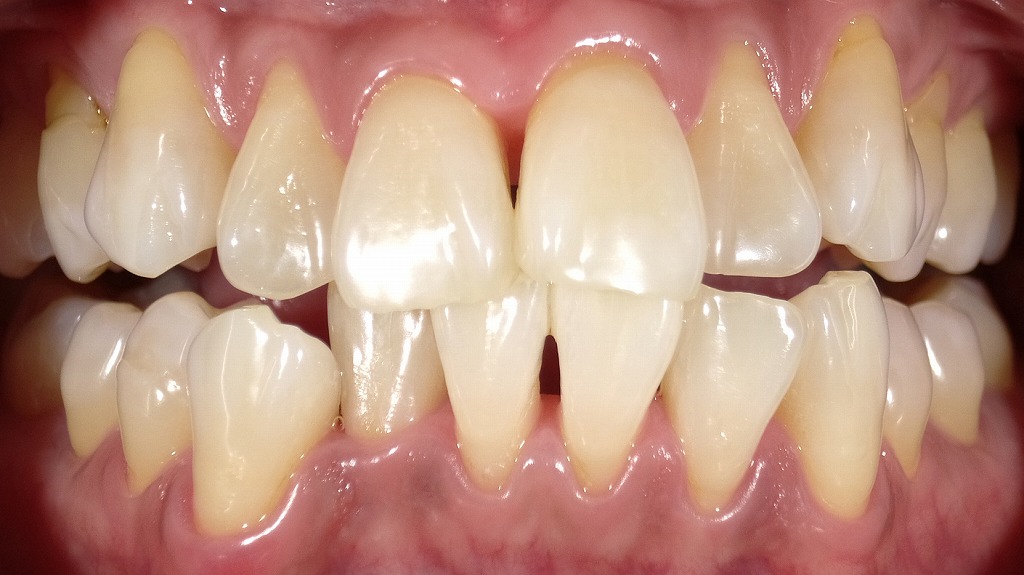 2枚目:ホワイトニング後