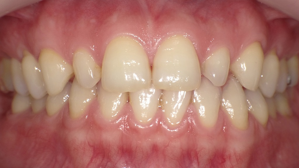 1枚目:ホワイトニング前