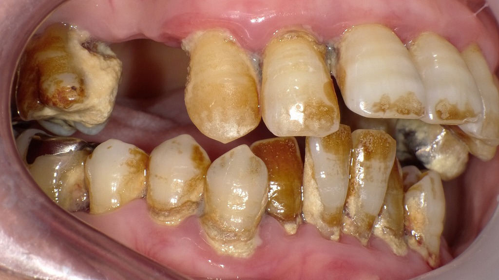 歯周病のにおいの原因|プラーク・歯石の大量付着