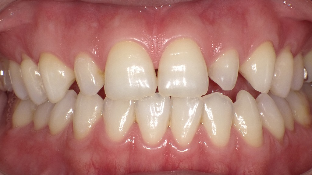 2枚目:ホワイトニング後