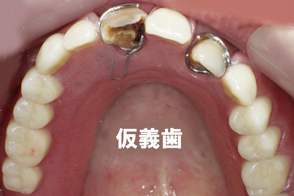 オーバーデンチャー型仮義歯の装着と咬合再構成