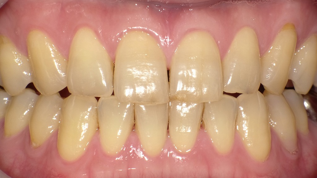 1枚目:ホワイトニング前