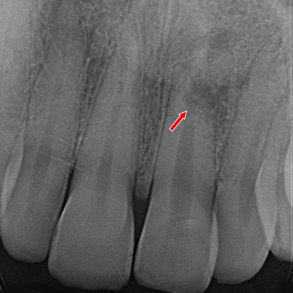「前歯部の病的歯根吸収(矢印)。外傷などによる外部吸収が疑われる不規則な透過像。