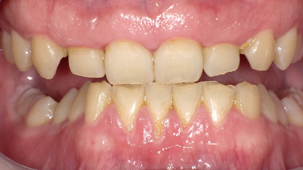 歯が短く見える症例