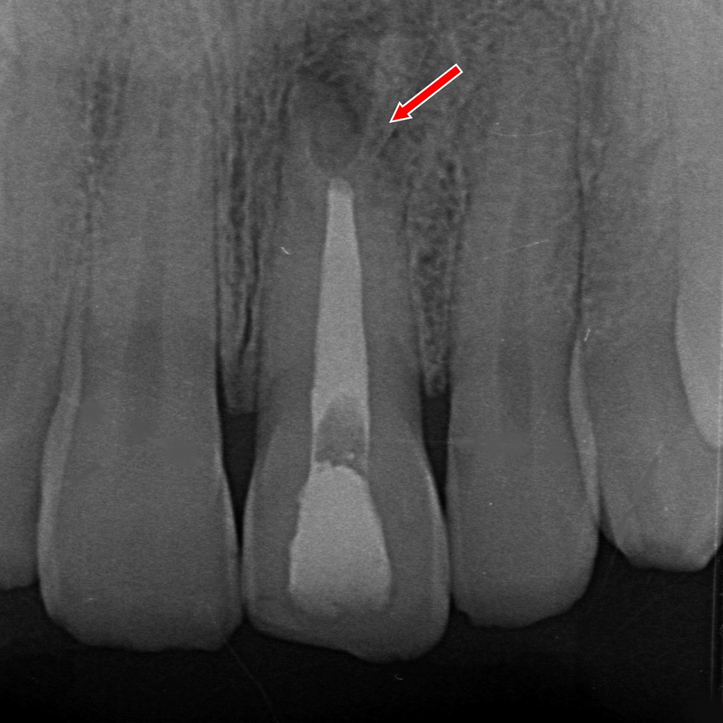 病的歯根吸収の根充後の経過観察像。吸収部の透過像は残存するが、根管は良好に封鎖され安定した状態。