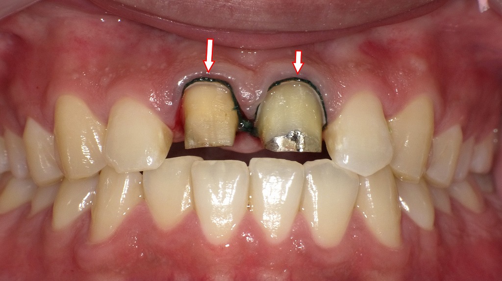 圧排糸を歯肉溝内に挿入