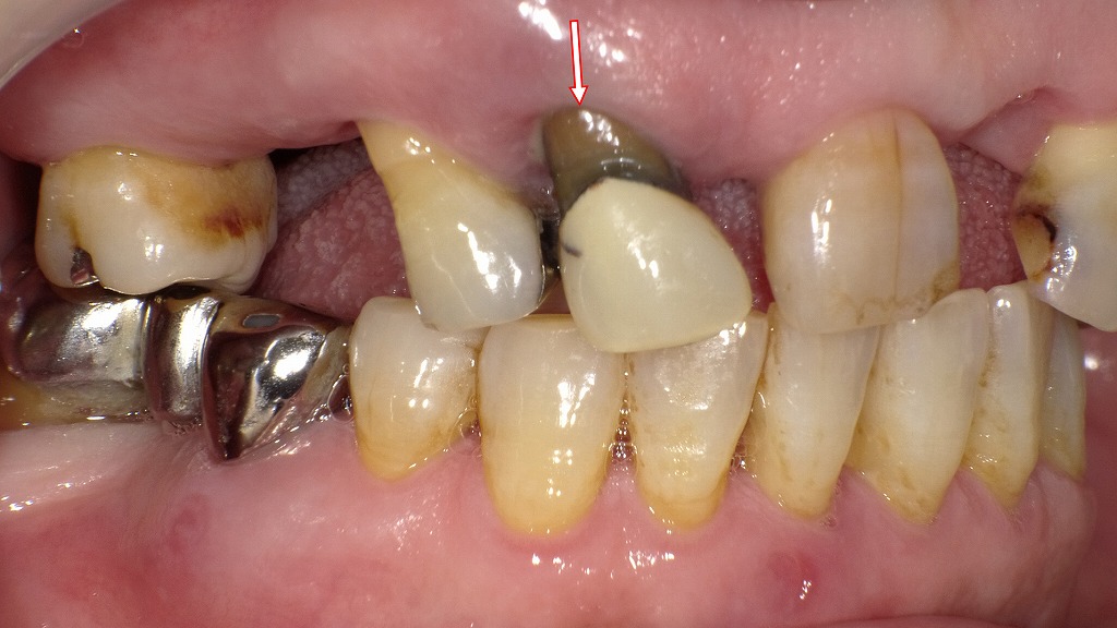 金属イオンによる歯根の変色