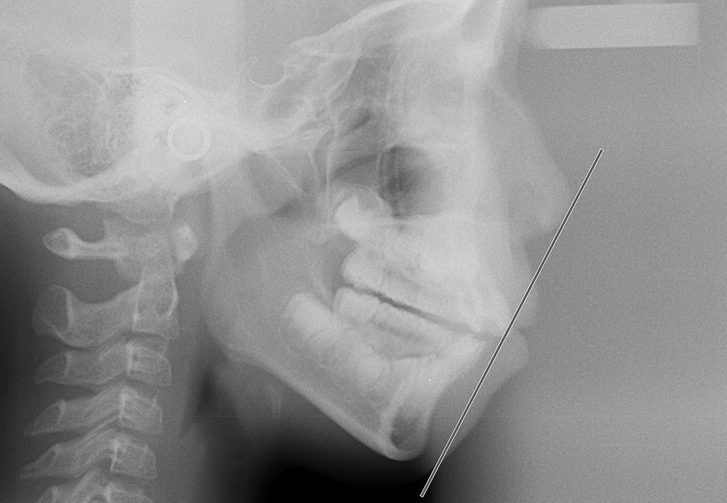 側面頭部X線規格写真（セファログラム）