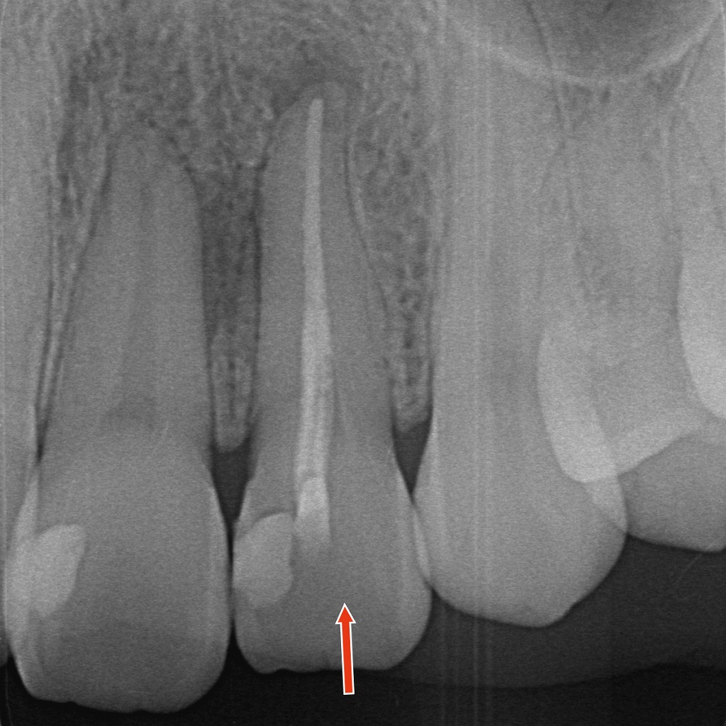 1枚目：レントゲン画像（神経のない前歯の状態）