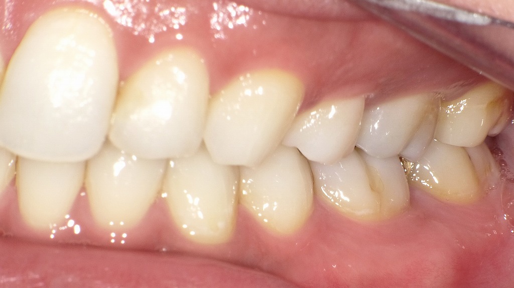 抜歯矯正後の左側面観