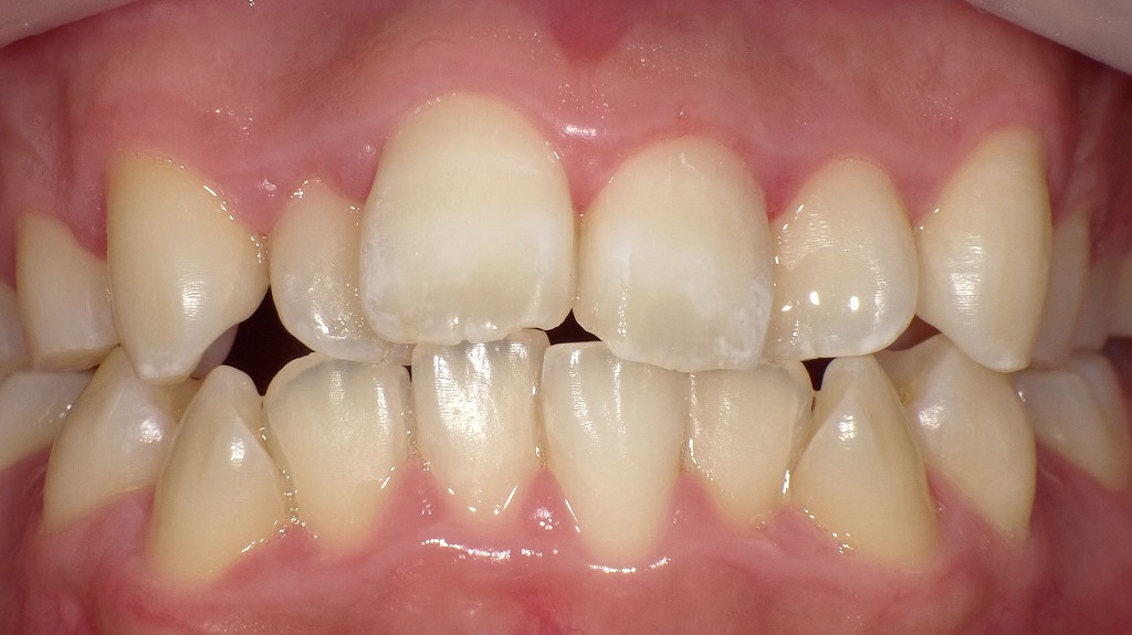 ホワイトスポットを改善した前歯（Icon治療後）