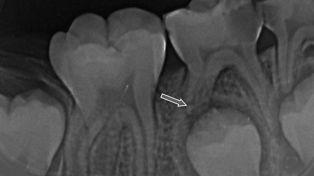 下顎E乳歯の生理的な歯根吸収。後方から萌出する第二小臼歯により、乳歯の歯根が自然に吸収している所見。
