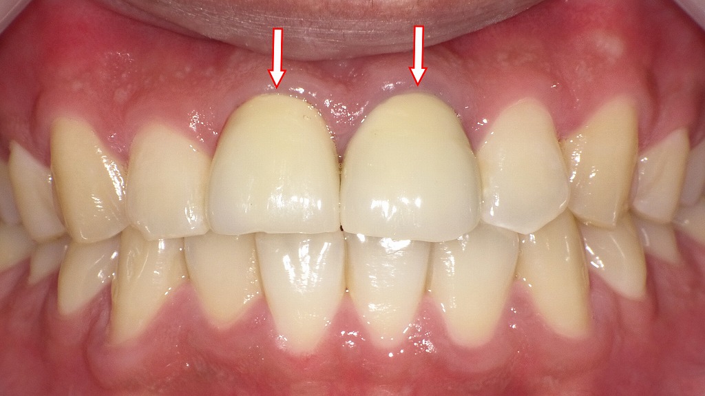 メタルボンドクラウンの装着