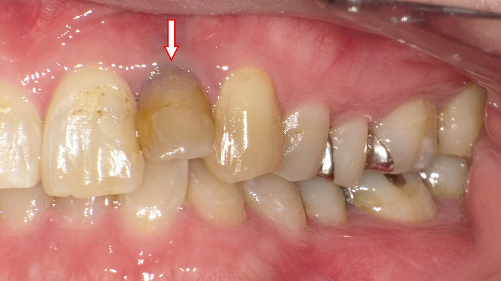 神経が死んだ歯（失活歯）の症例