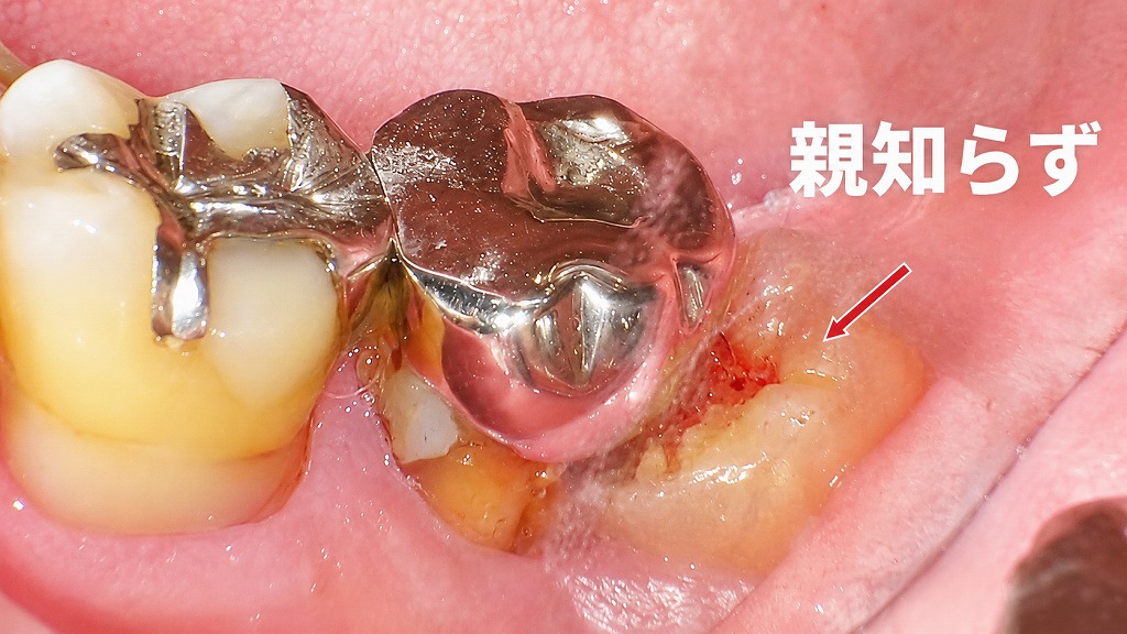半分だけ生えた親知らずは汚れが溜まりやすく、歯ぐきがジンジン痛む原因になります。
