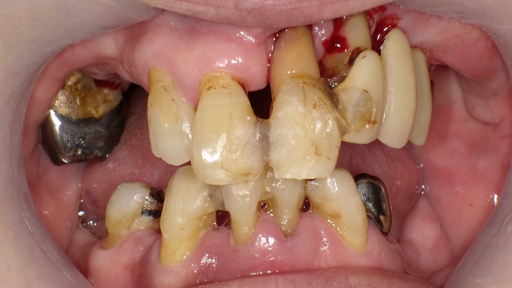 重度歯周病の症例