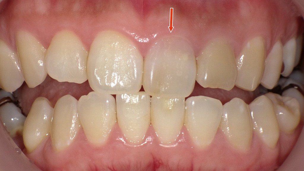 ホワイトニング前の口腔内写真
