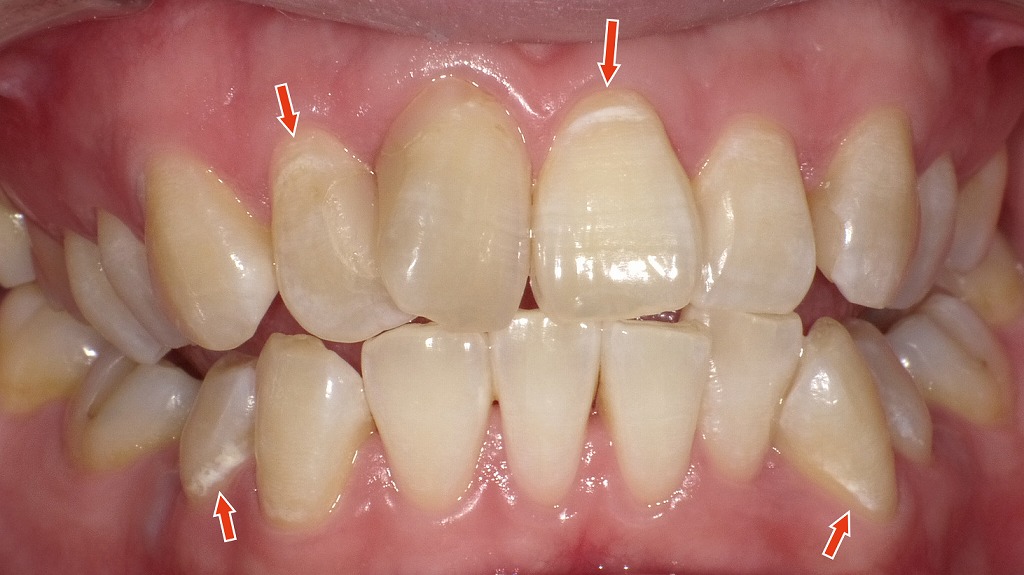 2枚目：ホワイトニング後