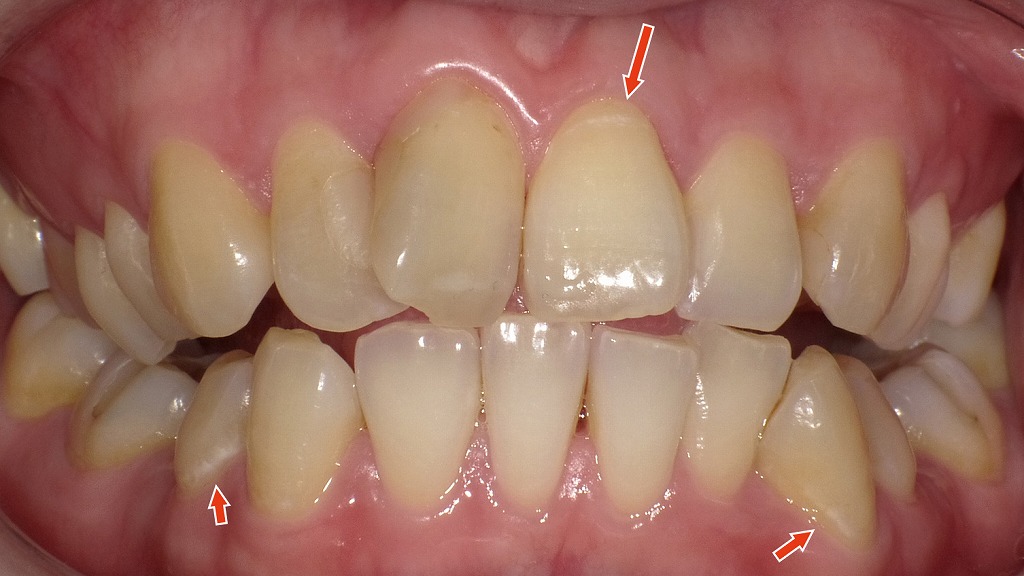 1枚目：ホワイトニング前