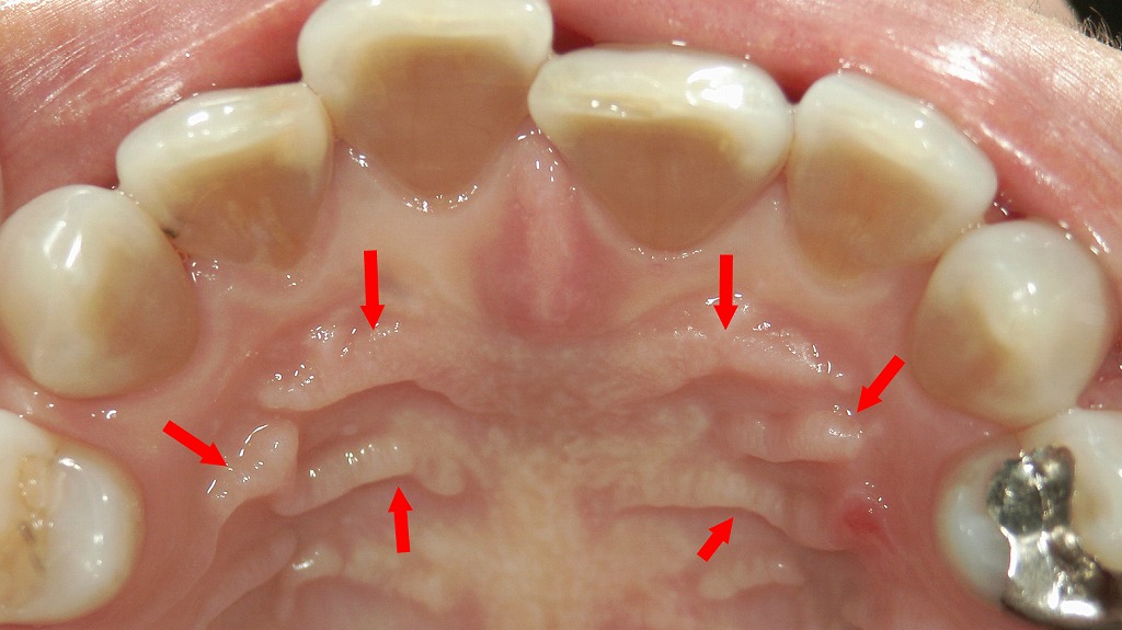 口蓋皺壁(こうがいすうへき)