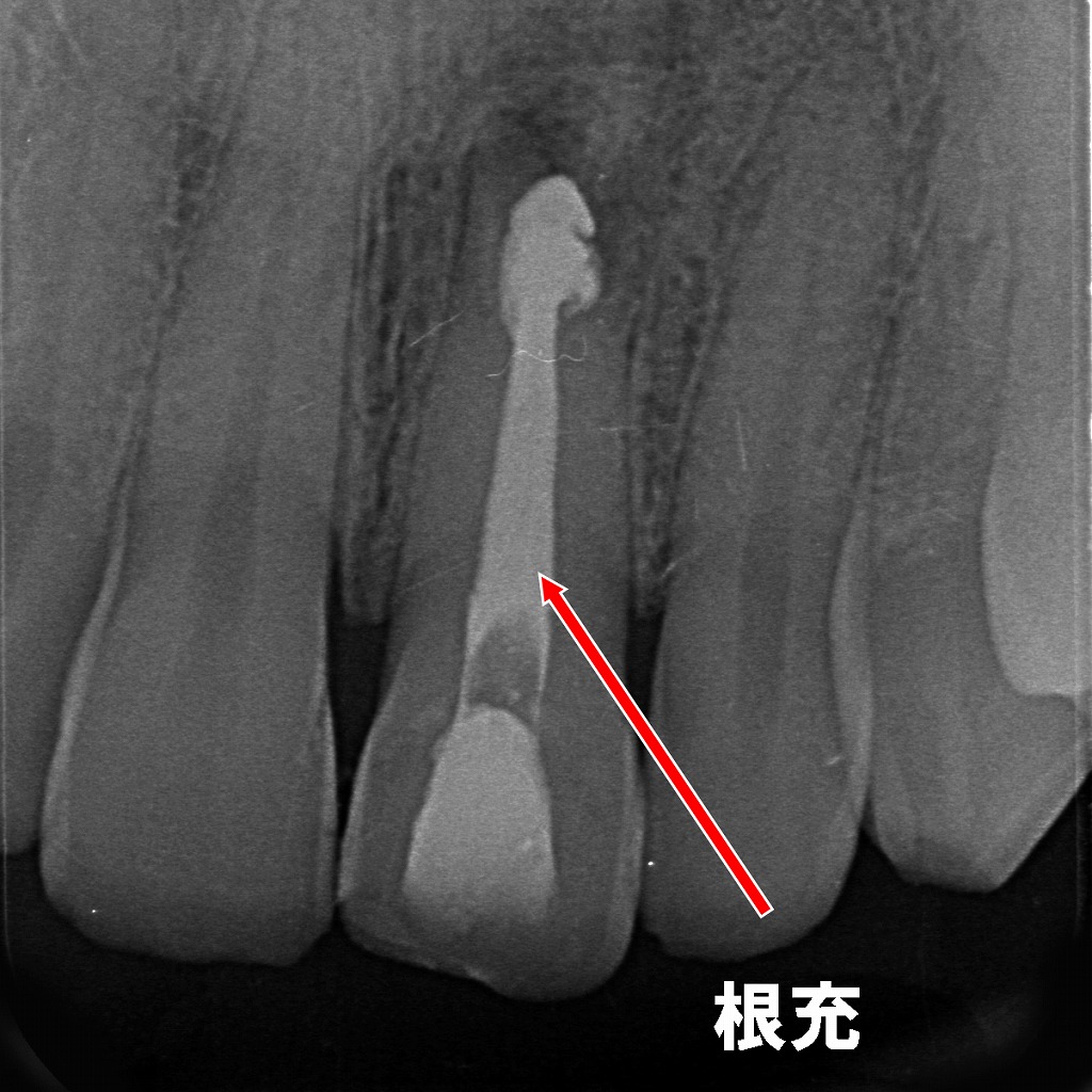 根充完了。吸収歯の根管が均一に封鎖され、感染源を除去した状態。