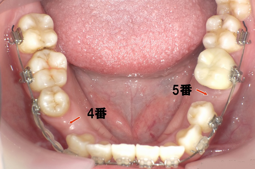 小臼歯抜歯後の矯正治療：下顎のスペース閉鎖の様子