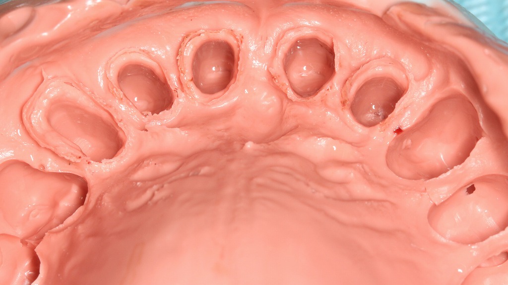 シリコーン印象＋歯肉圧排