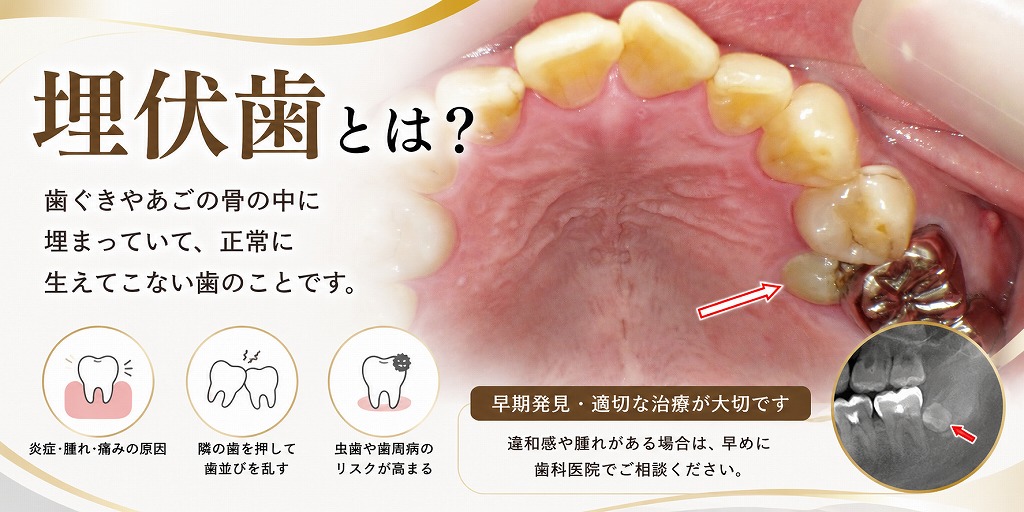 埋伏歯とは