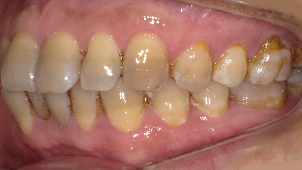 コーヒーなどによる着色が広く付着し、ブラッシングでは落とせない状態です。