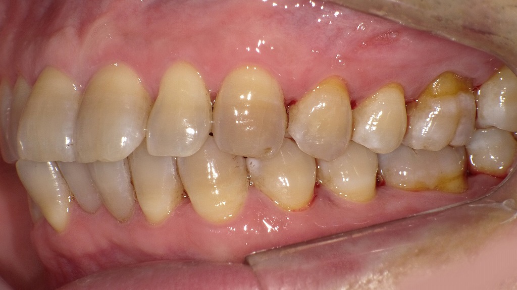 エアフローにより頑固なステインが除去され、歯本来の明るさが戻りました。