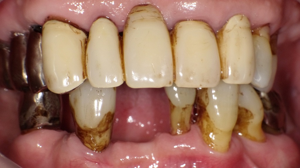 ステイン（着色汚れ）の症例