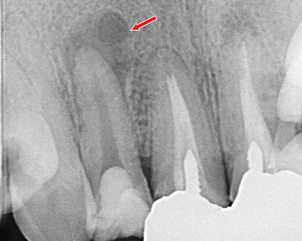 歯ぐきがジンジン痛む原因｜歯根の膿と根管治療が必要なケース