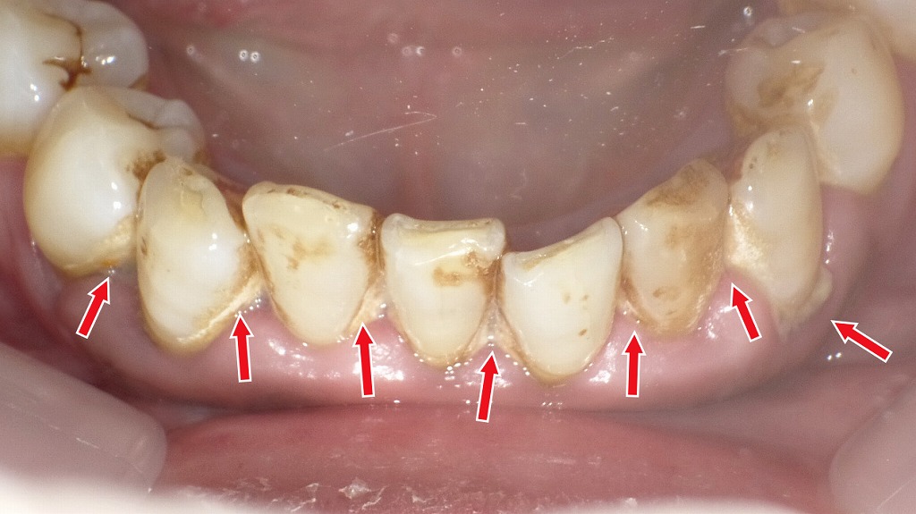 歯茎がジンジン痛む原因は？　歯垢・歯石がたまった状態の実例画像