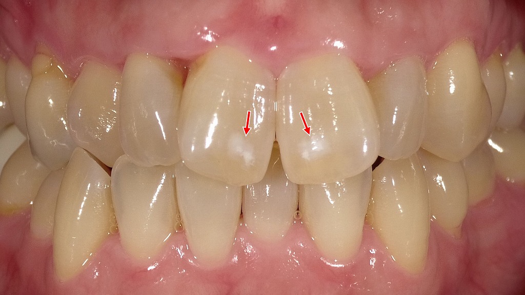 ホワイトニング前の前歯|ホワイトスポットが目立ちにくい状態