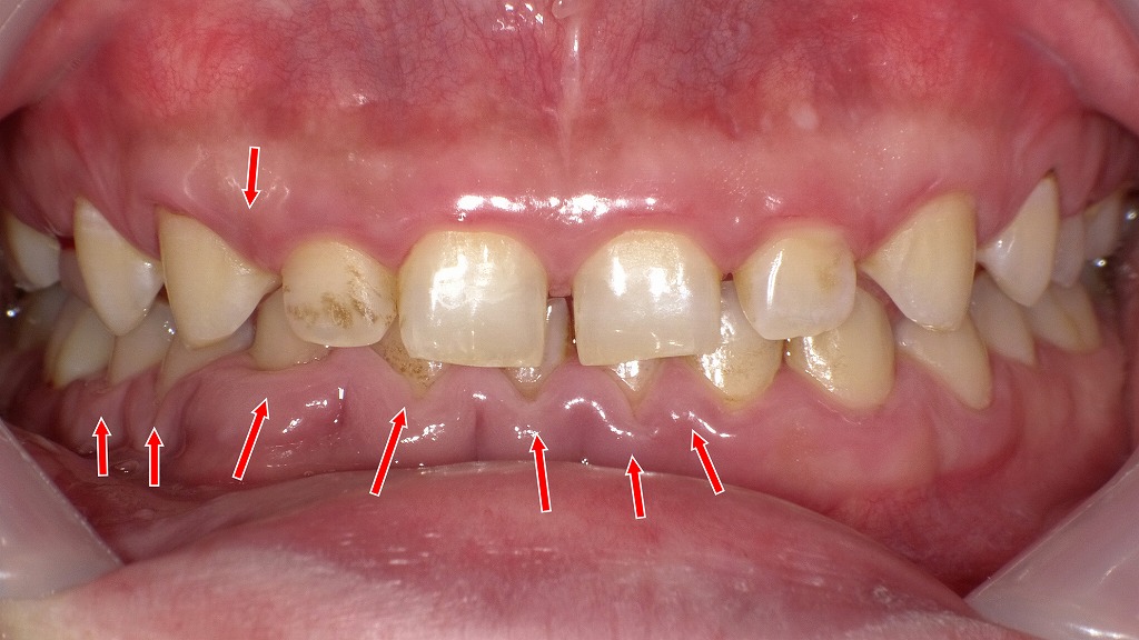 腫れた歯茎が刺激に反応し、ジンジンと痛む状態。
